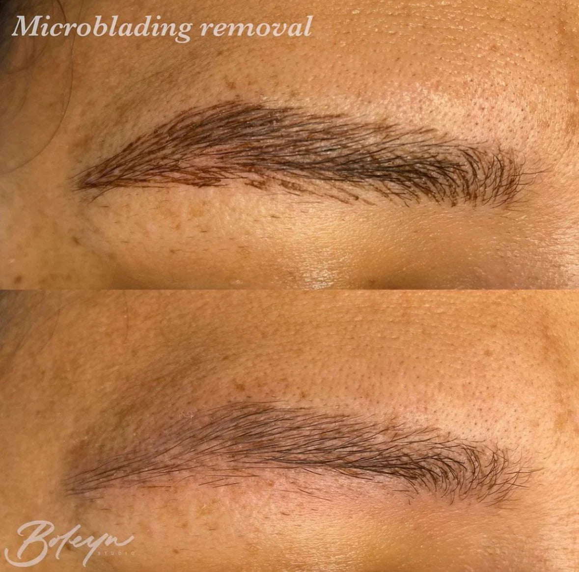 Tattoo/Microblading Removal