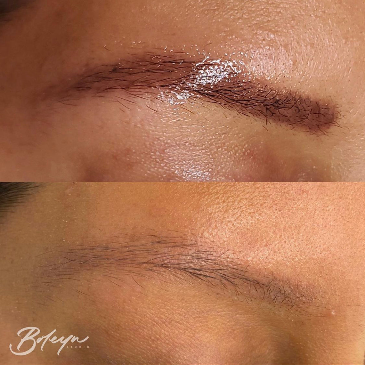 Tattoo/Microblading Removal