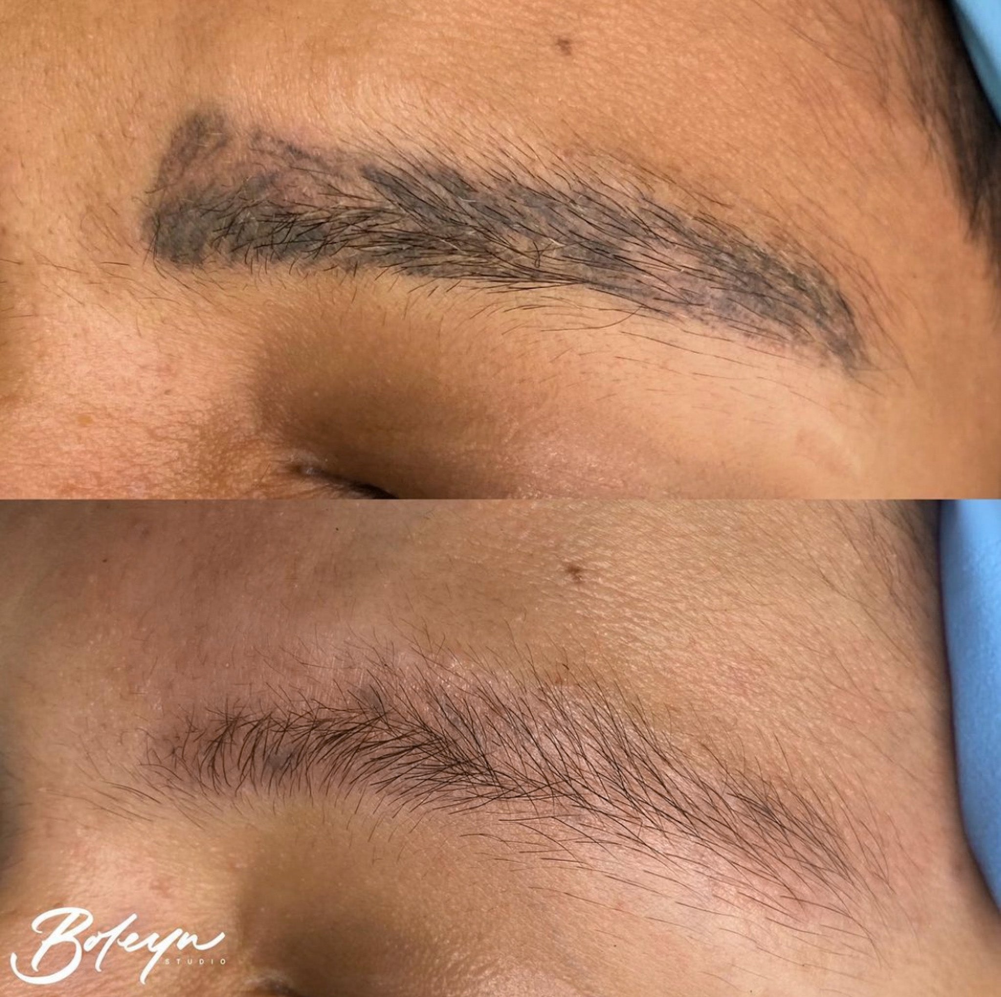 Tattoo/Microblading Removal (Deposit) - Follow Up Session