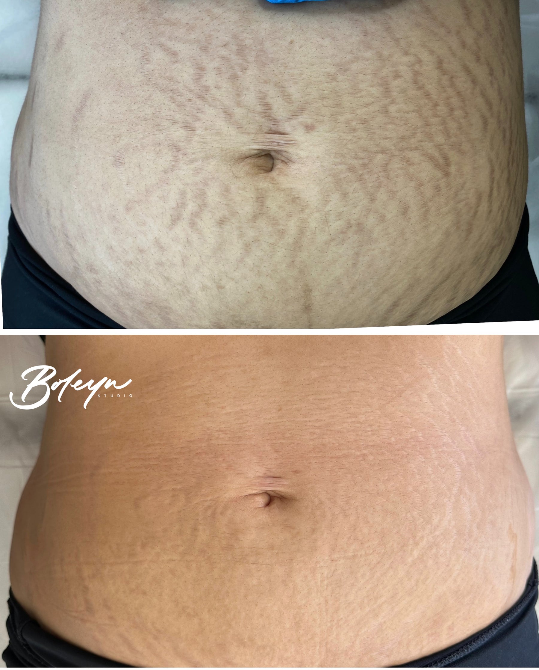 ⁠Boleyn Treatment Gallery